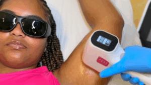 Laserbehandeling bij Be Bald in Rotterdam