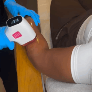 Laserbehandeling Rotterdam