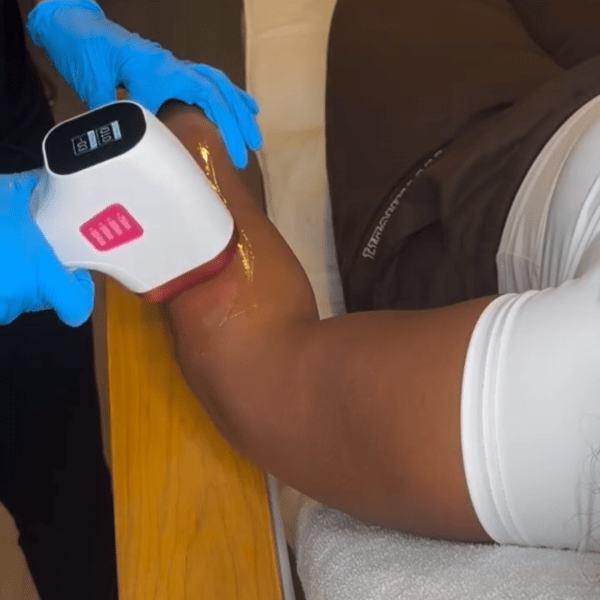 Laserbehandeling Rotterdam